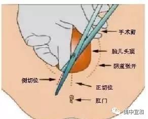 順產=側切/撕裂?避免被