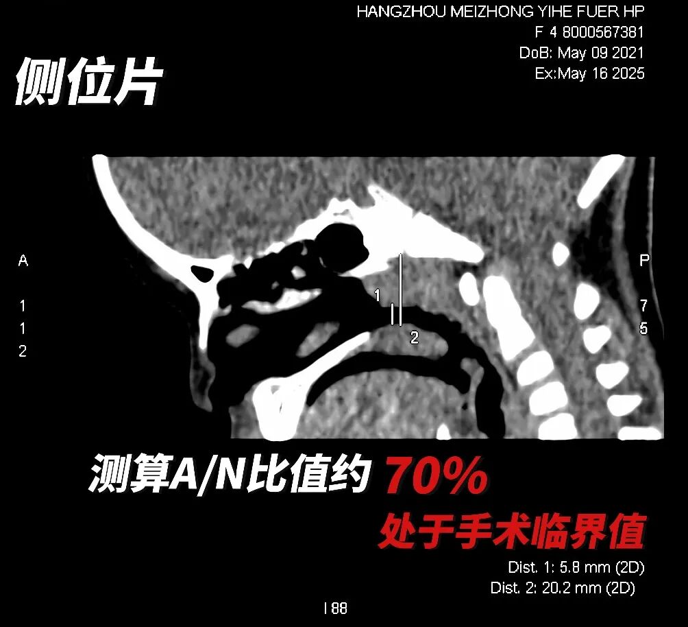孩子口呼吸、打鼾，要不要做CT？儿童专属模式&超低剂量CT，破解辐射焦虑！