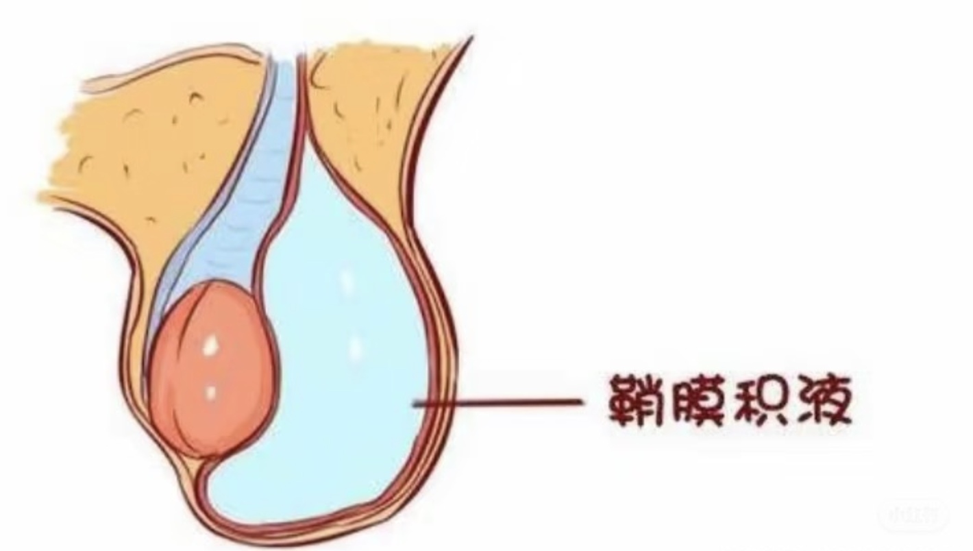 儿外科专家徐珊分享：宝宝查出鞘膜积液怎么办？