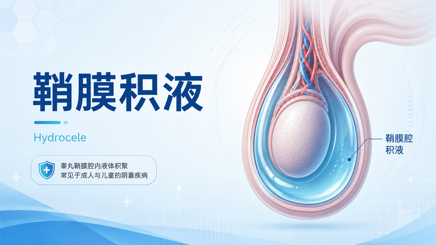 杭州美中宜和治疗鞘膜积液怎么样？