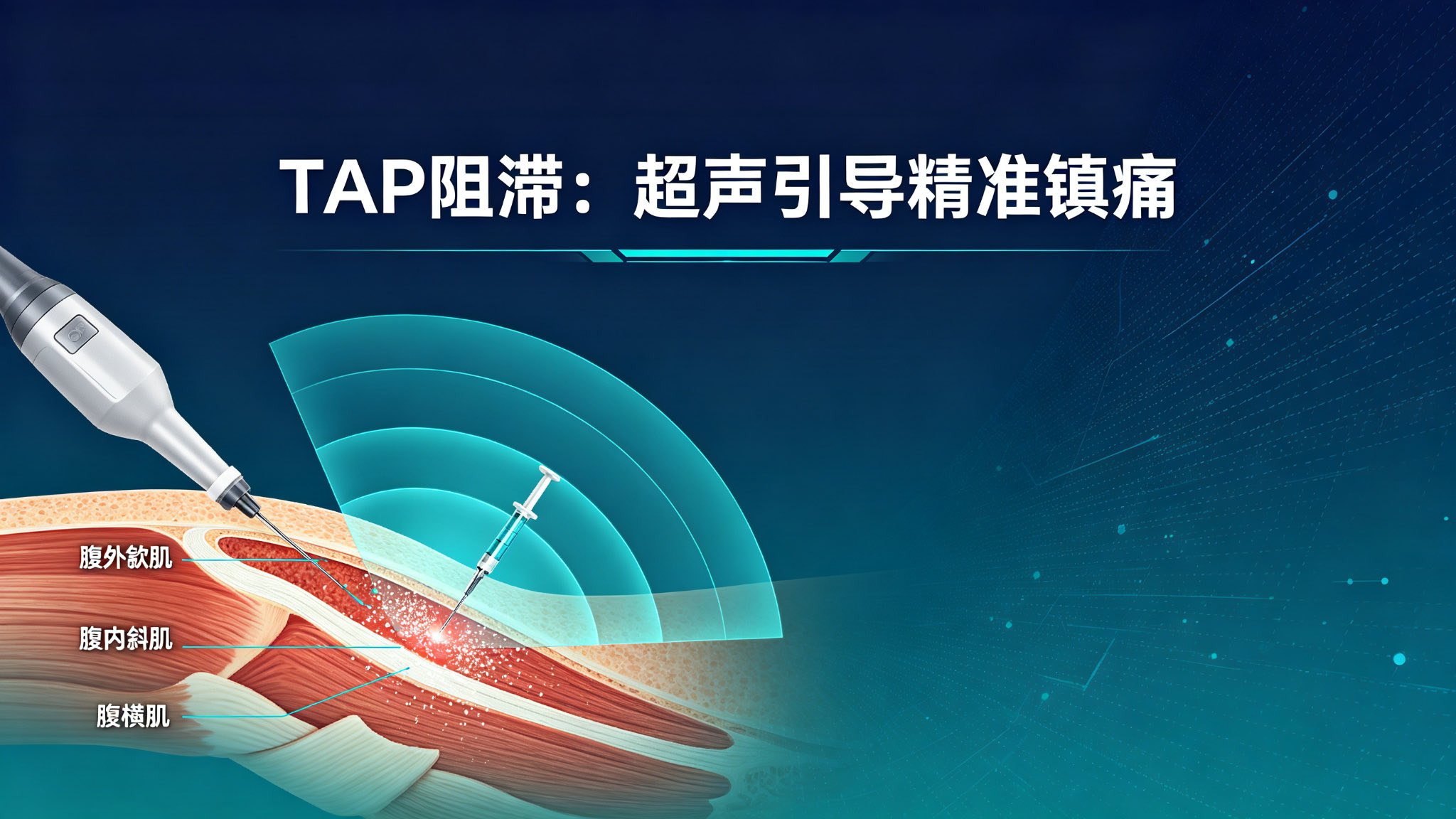 剖宫产术后疼痛难忍？TAP阻滞：超声引导精准镇痛