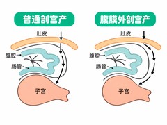 杭州美中宜和腹膜外剖宫产技术特色